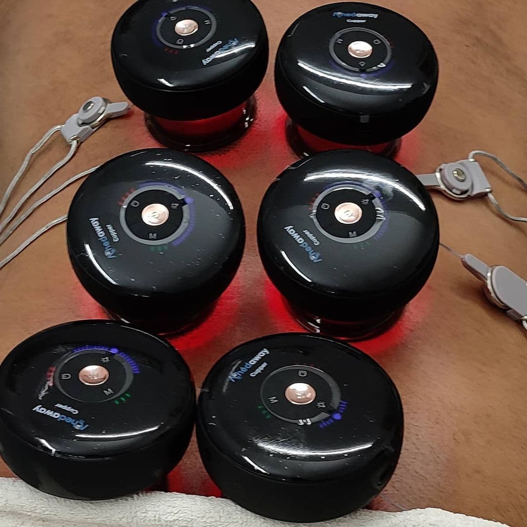 Dry Needling & Cupping